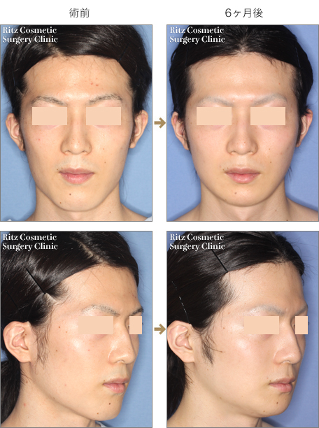 オトガイ あご の短縮 顎を短くする 症例 顔面輪郭形成術 Dr ヒロヒの顔面骨形成術