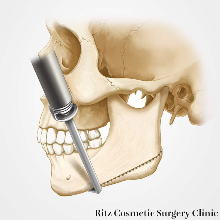 外板切除（分割法）：正面顔縮小術