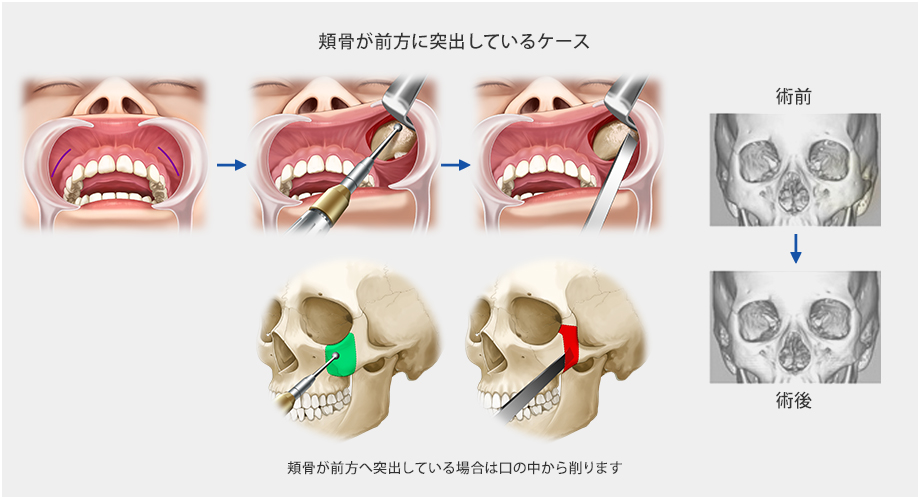頬骨が前方に突出しているケース：頬骨が前方への突出している場合は口の中から削ります