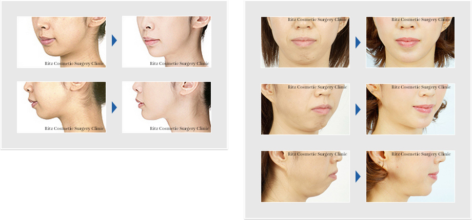 オトガイ あご の前進 顎を前に出す 症例 顔面輪郭形成術 Dr ヒロヒの顔面骨形成術