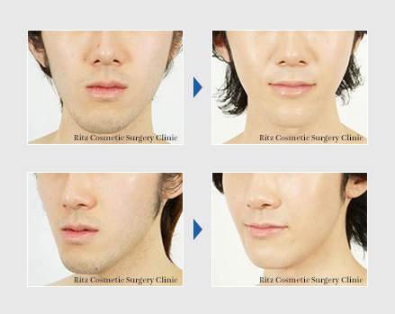 オトガイ あご の短縮 顎を短くする 症例 顔面輪郭形成術 Dr ヒロヒの顔面骨形成術