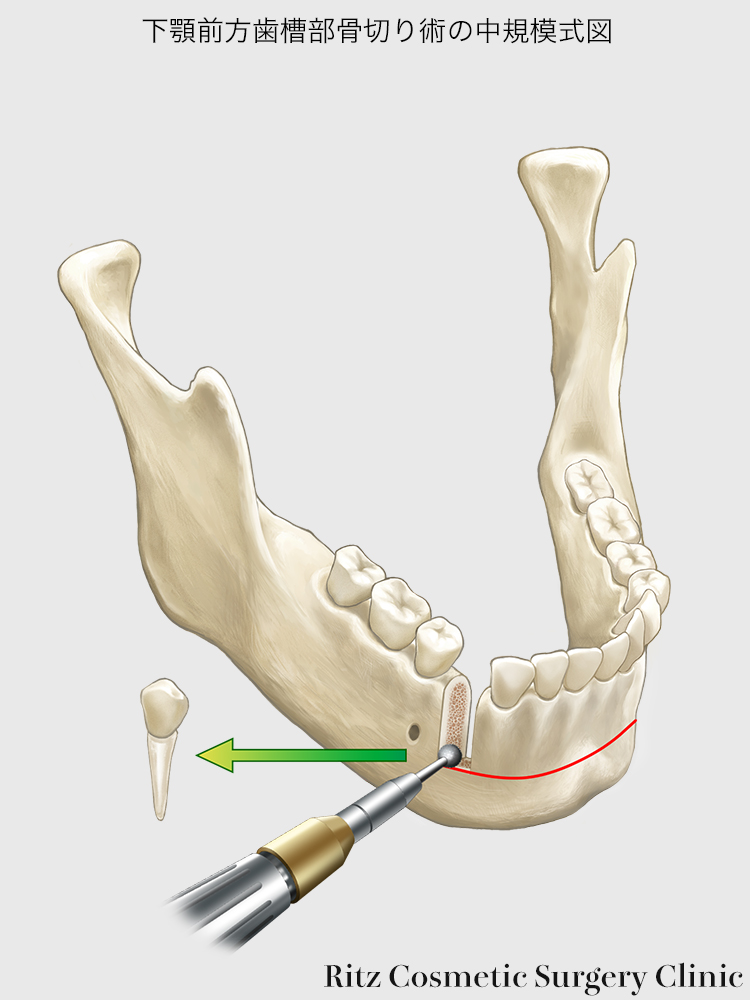 下顎前歯部歯槽骨切り術の中規模式図
