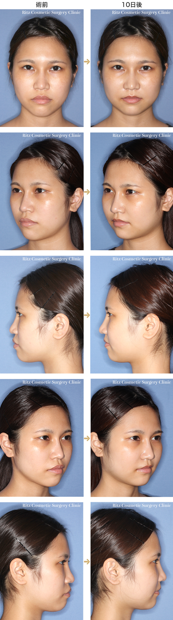 あご を引く 下顎枝矢状分割法 Ssro 症例 顎矯正手術 Dr ヒロヒの顔面骨形成術
