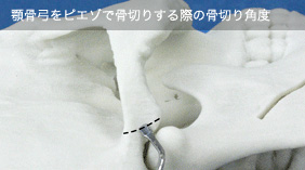 顎骨弓をピエゾで骨切りする際の骨切り角度