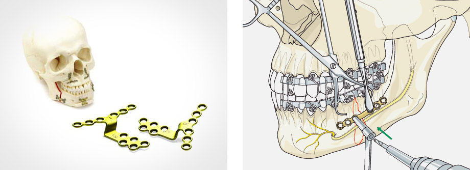 プレートシステム（骨固定用） | 医療機器 | Dr.ヒロヒの顔面骨形成術