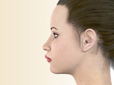 上顎ルフォー1型骨切り術（Lefort-1）