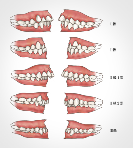 Angleの不正咬合の分類法