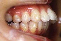 1. 歯槽性上顎前突症
